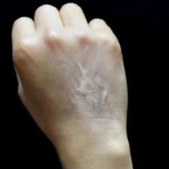 Out Of Kit Healed Burn Scar 1 Special FX