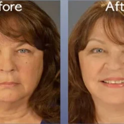 Skincare Art Harding Instant Face And Neck Lift 9 Skincare Art Harding Instant Face And Neck Lift