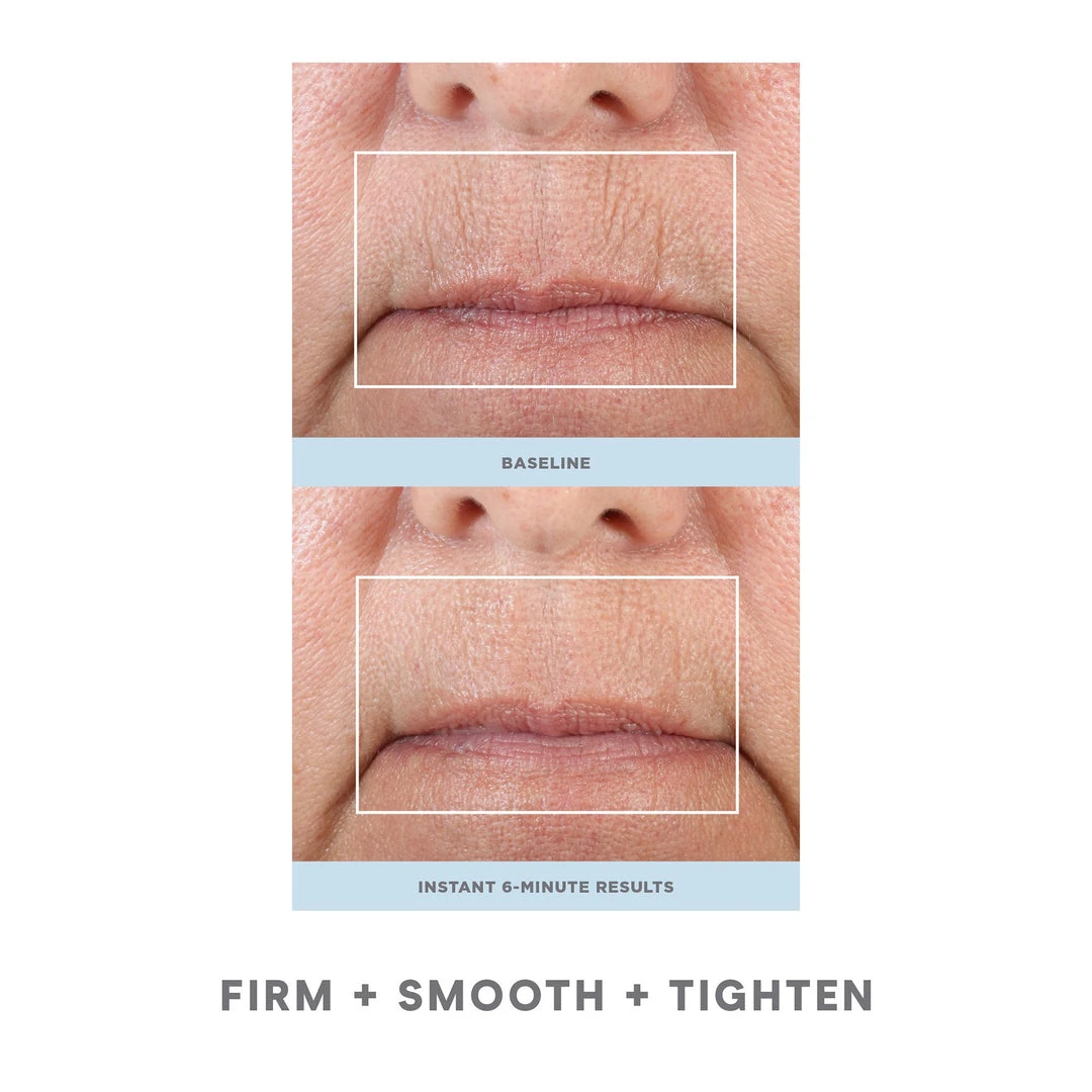 NuFACE FIX 4 NuFACE FIX