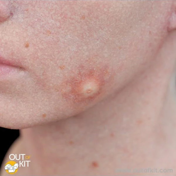 Special FX Out Of Kit Insect Bite (Large) 2 Special FX Out Of Kit Insect Bite (Large)